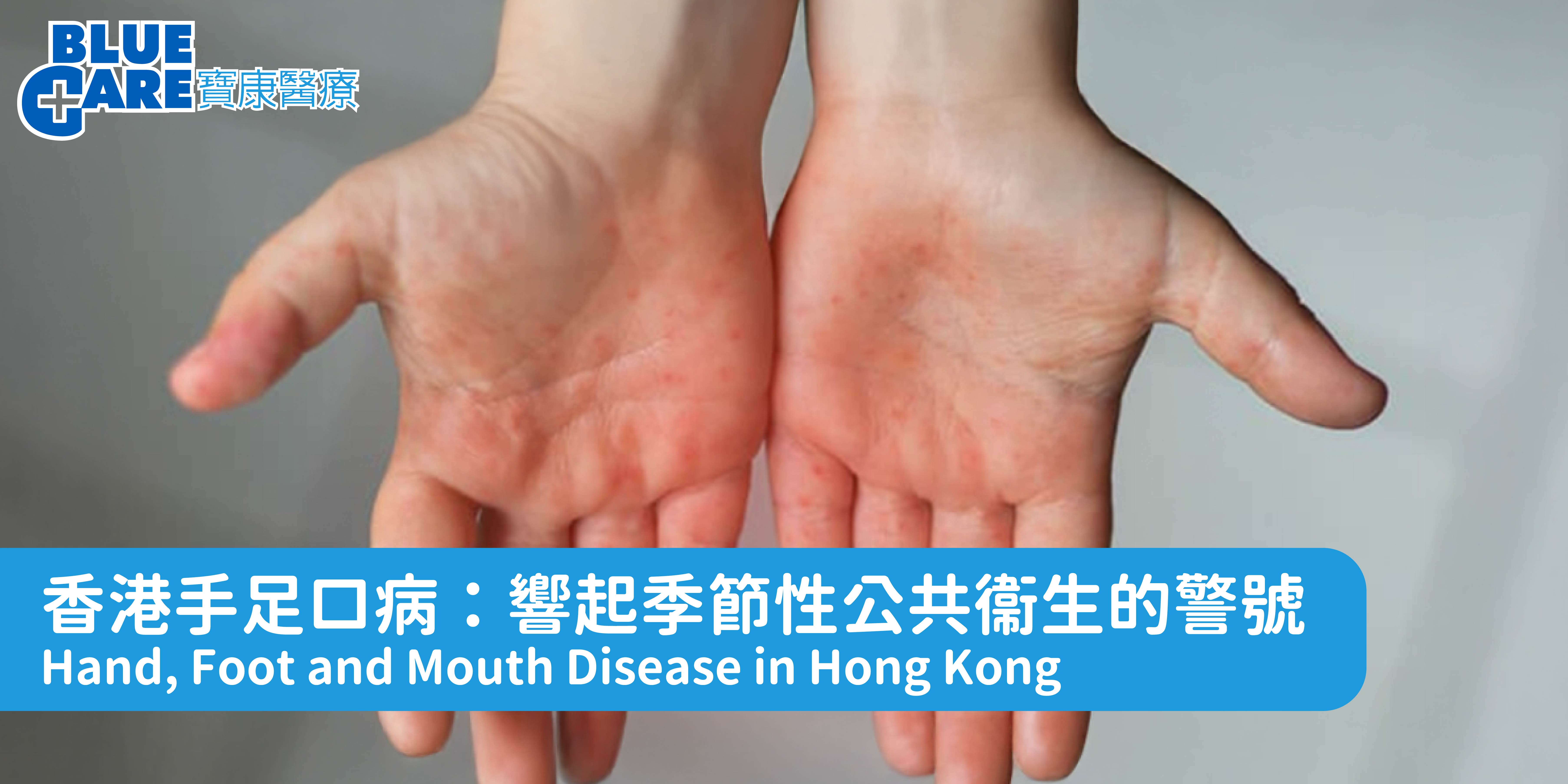 HFMD article