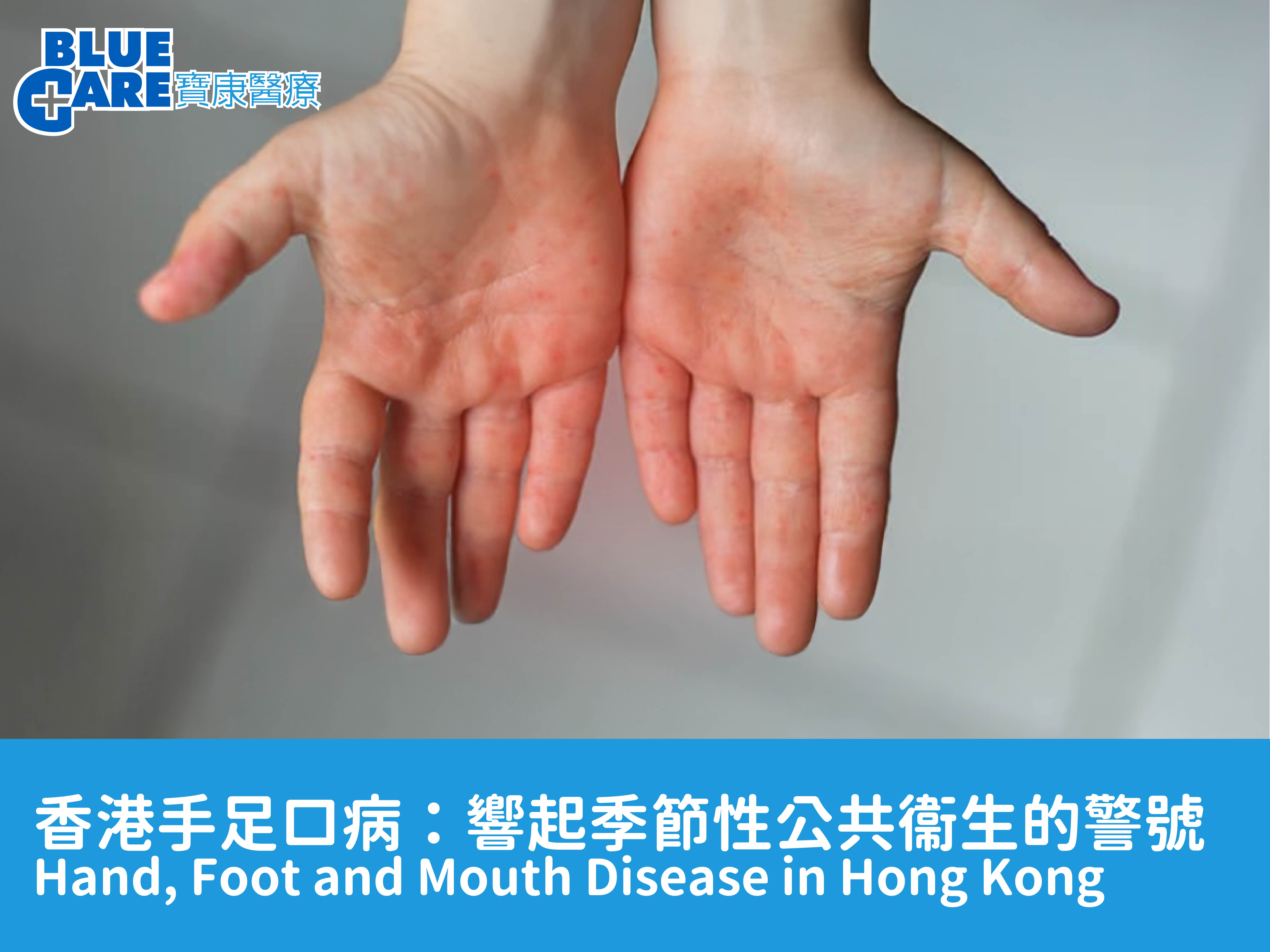 HFMD article